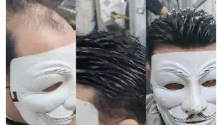 مميزات الشبكية الفرنسية وعيوب زراعة الشعر 01150543471