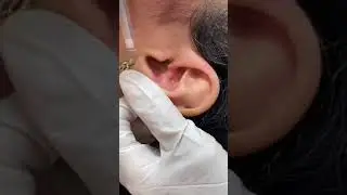 Pimple Popper Blackhead