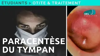Formation étudiant | Paracentèse du tympan