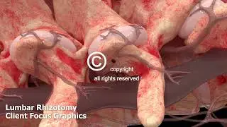 Lumbar Rhizotomy Animation