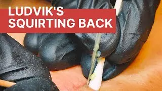 Ludvik's Squirting Back Full Of Blackheads (New Patient, 1st Session)