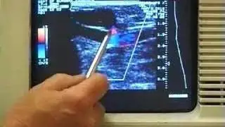Varicose vein 4