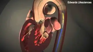 SNN: Heart surgery without opening the chest