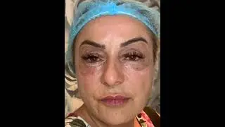 Non surgical Eye Lift with Plasma Fibroblast/instant result for hooded eyes/ageing skin/face lift