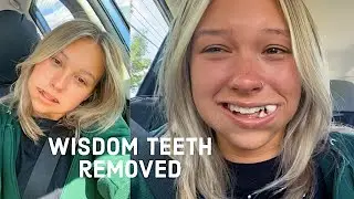 I got my wisdom teeth removed.