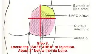 How to perform intramuscular (IM) injections - Testosterone, B12, BCAA, HCG, & other IM Injectables