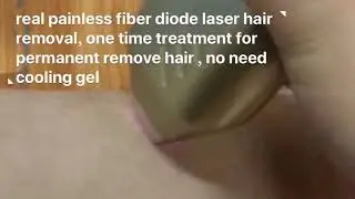 Best Fiber diode laser for hair removal