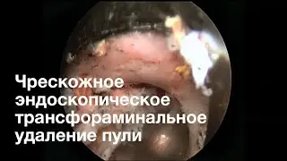 Чрескожное эндоскопическое трансфораминальное удаление пули.