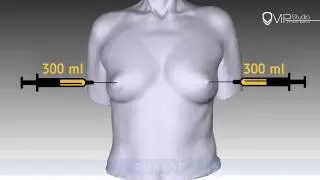 Липофиллинг груди / Fat Grafting ( хирург: Гурьянов А.С. )