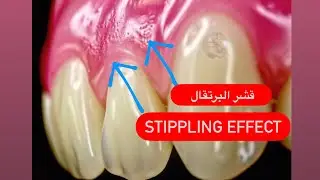 STIPPLING DENTURES/طريقة عمل لثة طبيعية