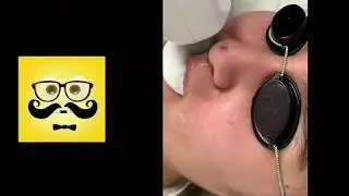 Лазерная эпиляция верхняя губа