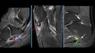MRI Ankle Case 10
