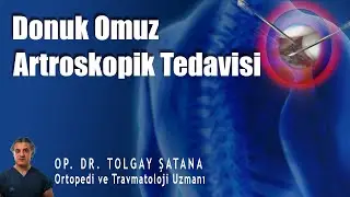 Donuk Omuz Artroskopik Tedavisi