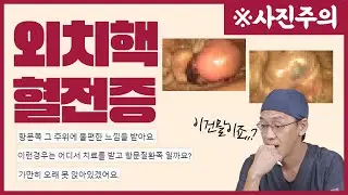 사진으로 보는 외치핵혈전증.  아프다! 나왔다! 피난다!
