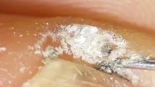 How to clean in depth lateral toenail fold #13