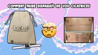 Comment faire disparaître les cicatrices de mammectomie // Cicalux // trans Ftm français // crazyden