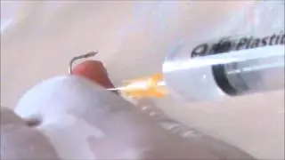 How to remove a fish hook dug in a finger