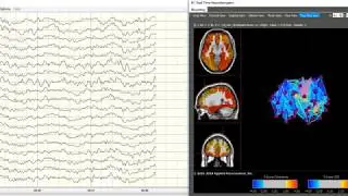 qEEG recording
