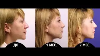 Скуловые имплантаты доктора Гурьянова.