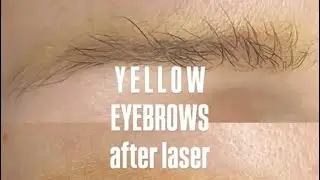 Yellow eyebrows, after laser