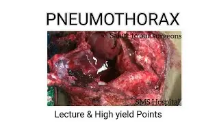 Pneumothorax Patient | Lecture & Golden points | Surgery Clinical | SMS Hospital