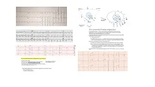 ECG QRS abnormalities- Part 1