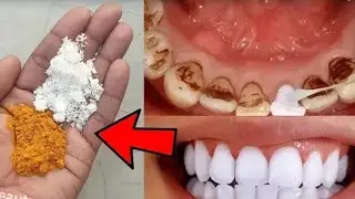 Teeth whitening home remedy 100% work