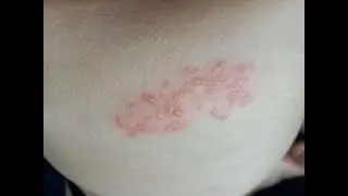Shingles vlog progression with pictures