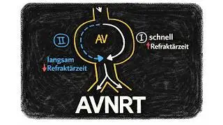 AV-Knoten Reentry Tachykardie (AVNRT) einfach erklärt