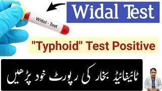 Widal Test Urdu Hindi - How To Read Typhoid Widal Test Report Widal Test Positive - Irfan Azeem
