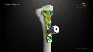 [ARIX Vet] CTWO Surgical Guide Animation