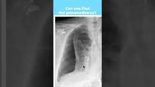 Can you find the pneumothorax? (Pt 3) 