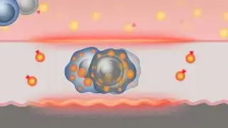 Vulnerable Plaque Test - Medical Animation by Watermark