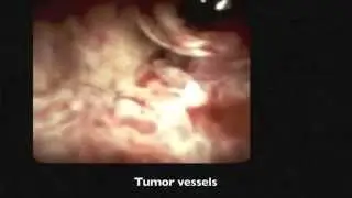 The Center for Interventional Endoscopy at Florida Hospital