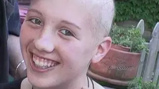 Alopecia- Firework, Katy Perry