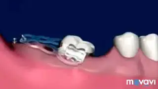 Ортодонтические импланты