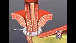 UC Health team offers Linx treatment for GERD