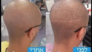 צלקות בראש נקודות בקרקפת | העלמת צלקות של השתלת שיער ~הדמייה