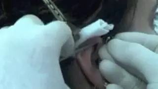 Helix Piercing (weird procedure)