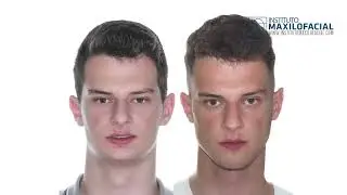 Jaw surgery Case # 105: Gustavo - Short face, overbite, maxilo-mandibular retrusion