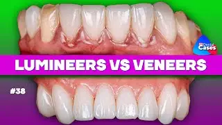 Lumineers VS Veneers | BG Dental Cases #38