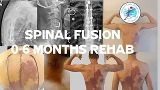 Spinal Fusion 0-6 months REHAB with WINBACK TECAR. HUGE RECOVERY after traumatic vertebral fracture