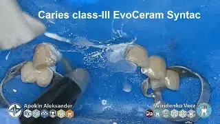 Caries class-III EvoCeram Syntac Sanctuary TorVM FABRI (multistream)
