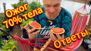 🔥 Ожог 70% Тела || Моя История и Ответы На Ваши Вопросы ❤️