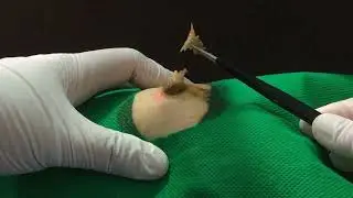 Treatment Of Blackhead Removal at Lam Dep Spa #045