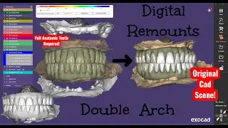 Exocad 3.3 Remount Workflow | Revise Your All-on-X Design Using New Bite Data (Same CAD Scene)