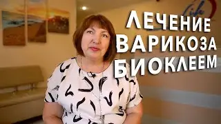 ЛЕЧЕНИЕ ВАРИКОЗА БИОКЛЕЕМ в АнгиоЛайф - отзыв пациента