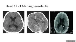 meningitis bakterial