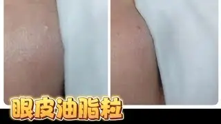 去除及避免形成眼部脂肪粒 SaMuu Beauty
