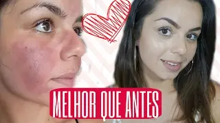 PÓS DERMAROLLER / RECUPERANDO  |  💛Lorena Rodrigues💛